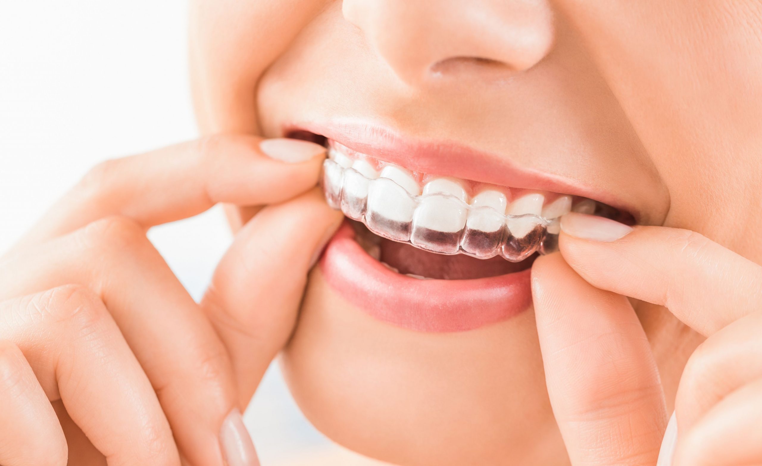 Como funciona o Invisalign? conheça os alinhadores transparentes! -  Dentista Tatuapé